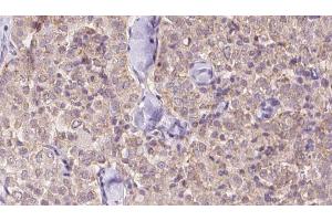 ABIN6273342 at 1/100 staining Human thyroid cancer tissue by IHC-P. (USP9X 抗体  (N-Term))