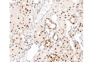 ABIN6267542 at 1/200 staining human kidney carcinoma tissue sections by IHC-P. (CEBPA 抗体  (pSer21))