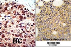 Formalin-fixed and paraffin-embedded human prostata carcinoma tissue reacted with PRMT3 Antibody (C-term) (ABIN387839 and ABIN2843941) , which was peroxidase-conjugated to the secondary antibody, followed by DAB staining. (PRMT3 抗体  (C-Term))