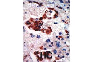 Formalin-fixed and paraffin-embedded human hepatocellular carcinoma tissue reacted with PRKCI polyclonal antibody  , which was peroxidase-conjugated to the secondary antibody, followed by AEC staining . (PKC iota 抗体  (N-Term))