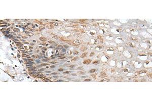 Immunohistochemistry of paraffin-embedded Human esophagus cancer tissue using CHRNA5 Polyclonal Antibody at dilution of 1:50(x200) (CHRNA5 抗体)