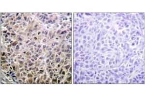 Immunohistochemistry analysis of paraffin-embedded human liver carcinoma tissue, using DAPK1 (Ab-308) Antibody. (DAP Kinase 1 抗体  (AA 274-323))