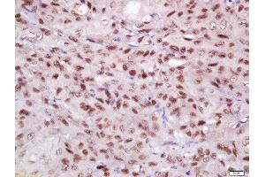 Formalin-fixed and paraffin embedded human laryngeal carcinoma tissue labeled with Rabbit Anti-EIF3S4 Polyclonal Antibody, Unconjugated  at 1:200 followed by conjugation to the secondary antibody and DAB staining (EIF3G 抗体  (AA 51-150))