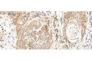 Immunohistochemistry of paraffin-embedded Human esophagus cancer tissue using GPSM1 Polyclonal Antibody at dilution of 1:55(x200) (GPSM1 抗体)