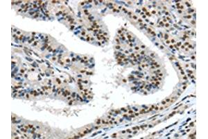 The image on the left is immunohistochemistry of paraffin-embedded Human thyroid cancer tissue using ABIN7131359(TKT Antibody) at dilution 1/30, on the right is treated with fusion protein. (TKT 抗体)