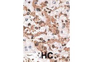 Formalin-fixed and paraffin-embedded human hepatocellular carcinoma tissue reacted with KCNIP3 polyclonal antibody  , which was peroxidase-conjugated to the secondary antibody, followed by AEC staining. (DREAM 抗体  (N-Term))