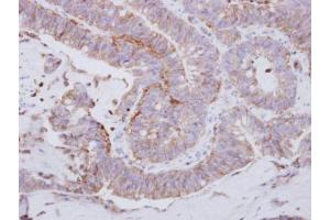 IHC-P Image Immunohistochemical analysis of paraffin-embedded human colon carcinoma, using LYN, antibody at 1:250 dilution. (LYN 抗体  (Center))