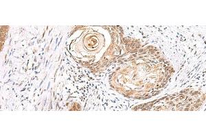 Immunohistochemistry of paraffin-embedded Human esophagus cancer tissue using EWSR1 Polyclonal Antibody at dilution of 1:70(x200) (EWSR1 抗体)