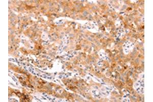 The image on the left is immunohistochemistry of paraffin-embedded Human lung cancer tissue using ABIN7189783(ALPPL2 Antibody) at dilution 1/20, on the right is treated with synthetic peptide. (ALPPL2 抗体)