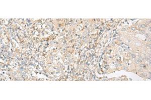 Immunohistochemistry of paraffin-embedded Human cervical cancer tissue using GLIS1 Polyclonal Antibody at dilution of 1:50(x200) (GLIS1 抗体)
