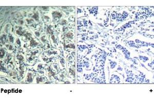 Immunohistochemical analysis of paraffin-embedded human breast carcinoma tissue using PLCG1 polyclonal antibody . (Phospholipase C gamma 1 抗体  (Tyr771))