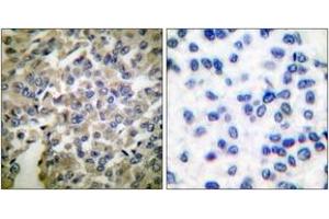 Immunohistochemistry analysis of paraffin-embedded human breast carcinoma tissue, using Synaptotagmin (Ab-309) Antibody. (Synaptotagmin 抗体  (AA 276-325))