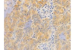 ABIN7097118 and ABIN7101185 at 1/100 staining human lung adenocarcinoma by IHC-P.