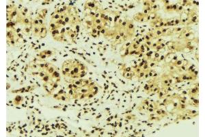 ABIN6276334 at 1/100 staining Human breast cancer tissue by IHC-P. (NME1 抗体  (C-Term))