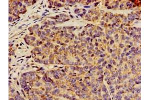 Immunohistochemistry of paraffin-embedded human ovarian cancer using ABIN7144300 at dilution of 1:100 (ANO1 抗体  (AA 1-151))