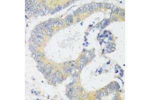 Immunohistochemistry of paraffin-embedded human colon carcinoma using Snail antibody (ABIN6132675, ABIN6148177, ABIN6148180 and ABIN6221190) at dilution of 1:100 (40x lens). (SNAIL 抗体  (C-Term))