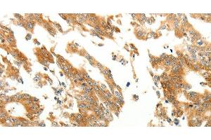 Immunohistochemistry of paraffin-embedded Human gastric cancer using RARRES1 Polyclonal Antibody at dilution of 1:60 (RARRES1 抗体)