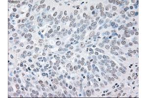 Immunohistochemical staining of paraffin-embedded Adenocarcinoma of colon tissue using anti-BRAFmouse monoclonal antibody. (BRAF 抗体)