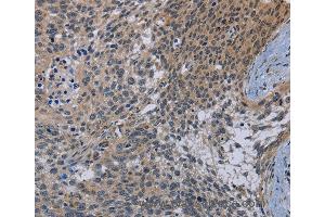 Immunohistochemistry of Human cervical cancer using CDC16 Polyclonal Antibody at dilution of 1:50 (CDC16 抗体)