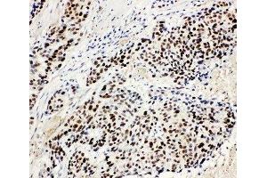 IHC-P: MCM3 antibody testing of human lung cancer tissue (MCM3 抗体  (N-Term))