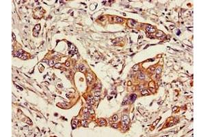 Immunohistochemistry of paraffin-embedded human pancreatic cancer using ABIN7169690 at dilution of 1:100 (STAT6 抗体  (AA 1-319))