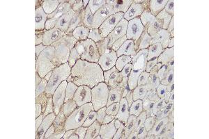 Immunohistochemistry of paraffin-embedded human esophageal cancer using TRPC6 Rabbit pAb (ABIN6133946, ABIN6149580, ABIN6149581 and ABIN6224178) at dilution of 1:150 (40x lens).