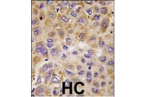 Formalin-fixed and paraffin-embedded human hepatocarcinoma tissue reacted with PFKFB1 antibody (Center), which was peroxidase-conjugated to the secondary antibody, followed by DAB staining. (PFKFB1 抗体  (AA 259-289))