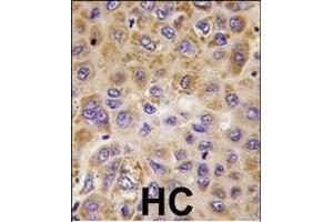 Formalin-fixed and paraffin-embedded human hepatocarcinoma tissue reacted with PFKFB1 antibody (Center), which was peroxidase-conjugated to the secondary antibody, followed by DAB staining.