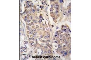 Formalin-fixed and paraffin-embedded human breast carcinoma tissue reacted with ACO2 antibody (Center) (ABIN391809 and ABIN2841660) , which was peroxidase-conjugated to the secondary antibody, followed by DAB staining. (ACO2 抗体  (AA 294-325))
