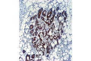 TGFB2 Antibody (ABIN659106 and ABIN2838086) immunohistochemistry analysis in formalin fixed and paraffin embedded human colon carcinoma followed by peroxidase conjμgation of the secondary antibody and DAB staining. (TGFB2 抗体)