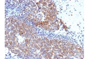 Formalin-fixed, paraffin-embedded human Melanoma stained with Topo I, MT Mouse Monoclonal Antibody (TOP1MT/568). (TOP1MT 抗体)