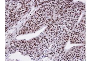 IHC-P Image Immunohistochemical analysis of paraffin-embedded HeLa xenograft, using CTDP1 , antibody at 1:100 dilution. (CTDP1 抗体  (N-Term))
