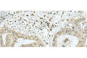 Immunohistochemistry of paraffin-embedded Human thyroid cancer tissue using THTPA Polyclonal Antibody at dilution of 1:70(x200) (THTPA 抗体)