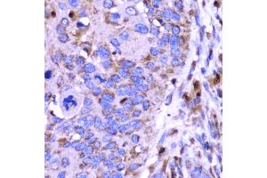 Immunohistochemistry of paraffin-embedded human esophageal cancer using SPARC antibody (ABIN5970787) at dilution of 1/100 (40x lens). (SPARC 抗体)