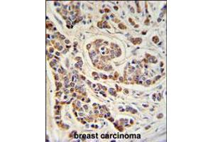 ATHL1 Antibody IHC analysis in formalin fixed and paraffin embedded human breast carcinoma followed by peroxidase conjugation of the secondary antibody and DAB staining. (ATHL1 抗体  (C-Term))