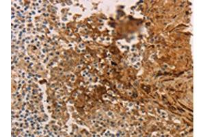 The image on the left is immunohistochemistry of paraffin-embedded Human tonsil tissue using ABIN7189672(ADCYAP1R1 Antibody) at dilution 1/70, on the right is treated with synthetic peptide. (ADCYAP1R1 抗体)