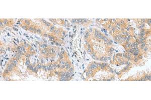 Immunohistochemistry of paraffin-embedded Human lung cancer tissue using RPS16 Polyclonal Antibody at dilution of 1:60(x200) (RPS16 抗体)