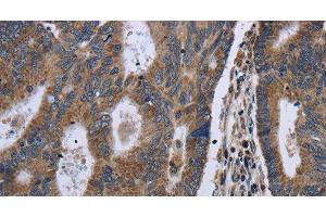 Immunohistochemistry of paraffin-embedded Human colon cancer using GSTA3 Polyclonal Antibody at dilution of 1:30 (GSTA3 抗体)