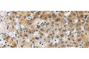 Immunohistochemistry of paraffin-embedded Human liver cancer tissue using PLIN4 Polyclonal Antibody at dilution of 1:50(x200) (PLIN4 抗体)