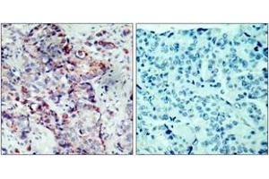 Immunohistochemistry analysis of paraffin-embedded human breast carcinoma, using SEK1/MKK4 (Phospho-Ser80) Antibody. (MAP2K4 抗体  (pSer80))