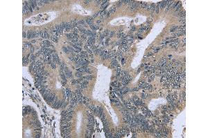 Immunohistochemistry of Human cervical cancer using BMX Polyclonal Antibody at dilution of 1:30 (BMX 抗体)