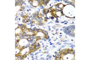 Immunohistochemistry of paraffin-embedded human gastric cancer using AMY2A antibody at dilution of 1:100 (x40 lens). (AMY2A 抗体)