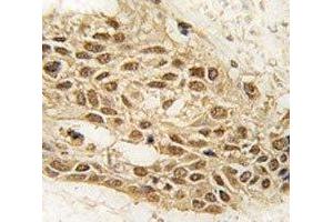 IHC analysis Dnmt3a antibody and human lung carcinoma tissue (DNMT3A 抗体  (AA 31-61))