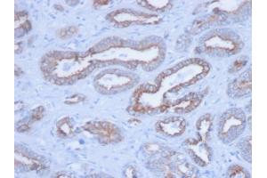 Formalin-fixed, paraffin-embedded human Prostate stained with Pan-Cytokeratin Mouse Monoclonal Antibody (PCK/3150). (KRT 抗体)