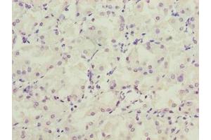 Immunohistochemistry of paraffin-embedded human gastric cancer using ABIN7158154 at dilution of 1:100 (LRRC2 抗体  (AA 1-184))