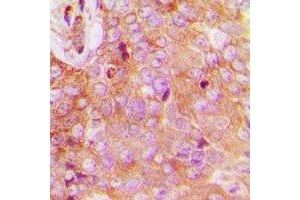 Immunohistochemical analysis of FAM84B staining in human breast cancer formalin fixed paraffin embedded tissue section. (FAM84B 抗体  (N-Term))