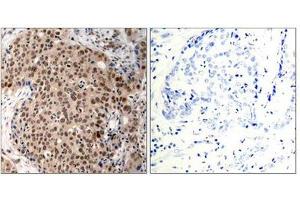 Immunohistochemical analysis of paraffin-embedded human breast carcinoma tissue using MAPKAPK-2(Phospho-Thr334) Antibody(left) or the same antibody preincubated with blocking peptide(right). (MAPKAP Kinase 2 抗体  (pThr334))