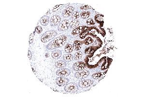 Moderate to strong CEA immunostaining in the epithelial cells of the colon. (Recombinant CEA 抗体)