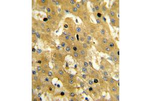 Formalin-fixed and paraffin-embedded human hepatocarcinoma reacted with SCP2 Antibody (Center), which was peroxidase-conjugated to the secondary antibody, followed by DAB staining. (SCP2 抗体  (AA 358-385))