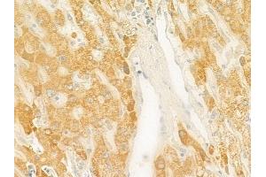 ABIN6261293 and ABIN6279350 at 1/100 staining human hepatocellular carcinoma by IHC-P. (DHRS9 抗体  (Internal Region))